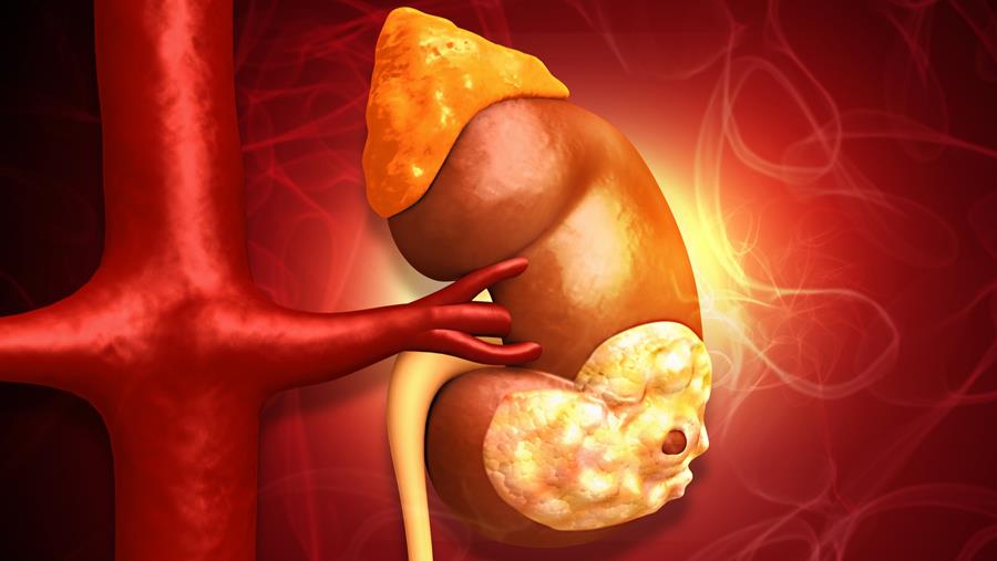 Cancer du rein : le durvalumab seul ne confirme pas en adjuvant