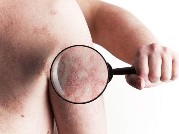 Nieuwe psoriasis-behandelingen doen budget dermatologen exploderen