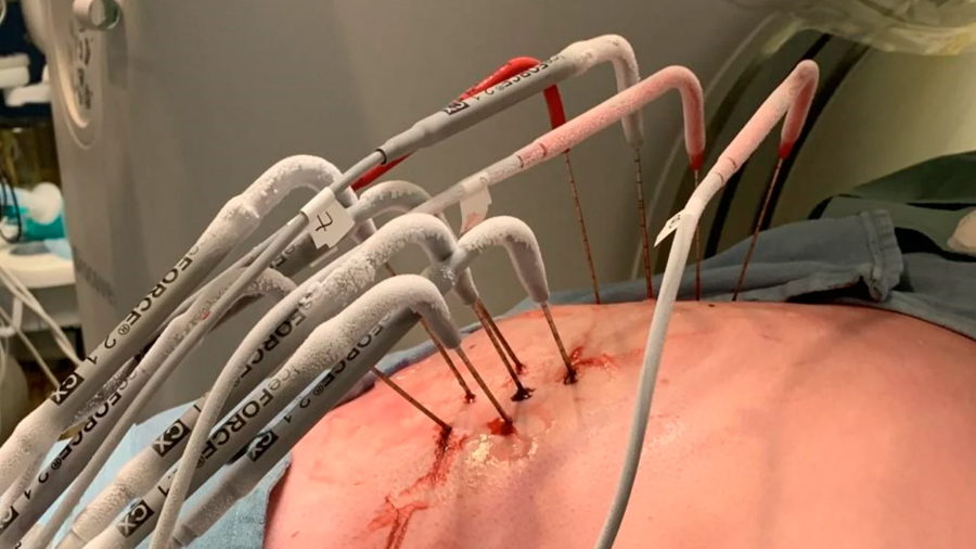 La cryoablation se profile comme le traitement du futur pour les tumeurs desmoïdes